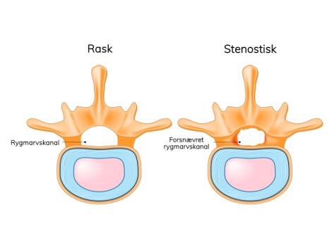 Spinalstenose ryg