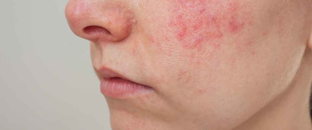 Hvordan kan rosacea behandles?