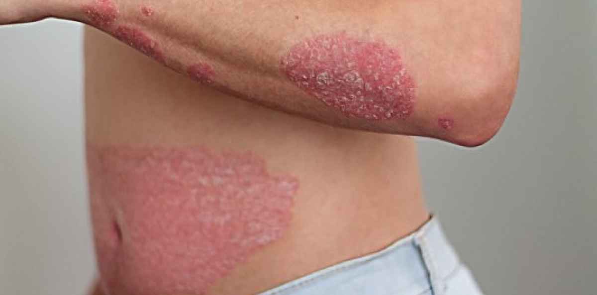 Hvad er psoriasis?