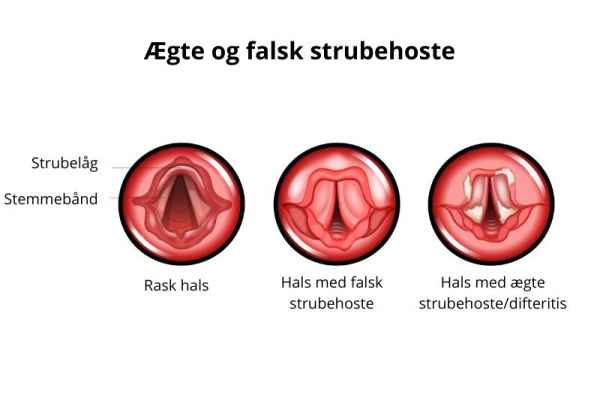 Illustration af ægte og falsk strubehoste