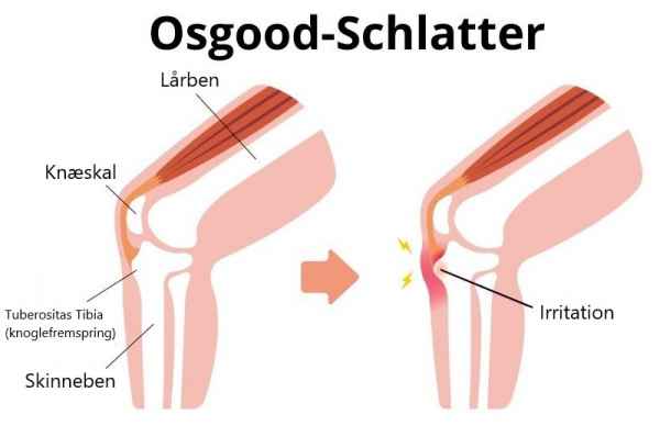 osgood schlatter