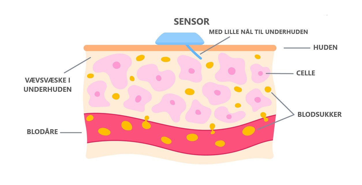 Blodsukkermåler med sensor, der måler blodsukkeret i vævsvæsken i underhuden. Foto: Istock