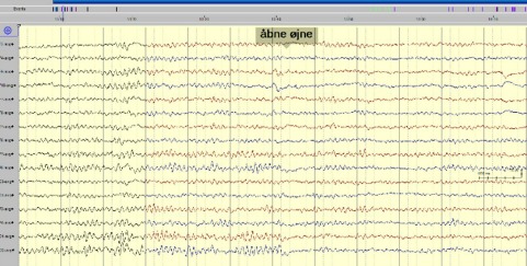 EEG aktivitet